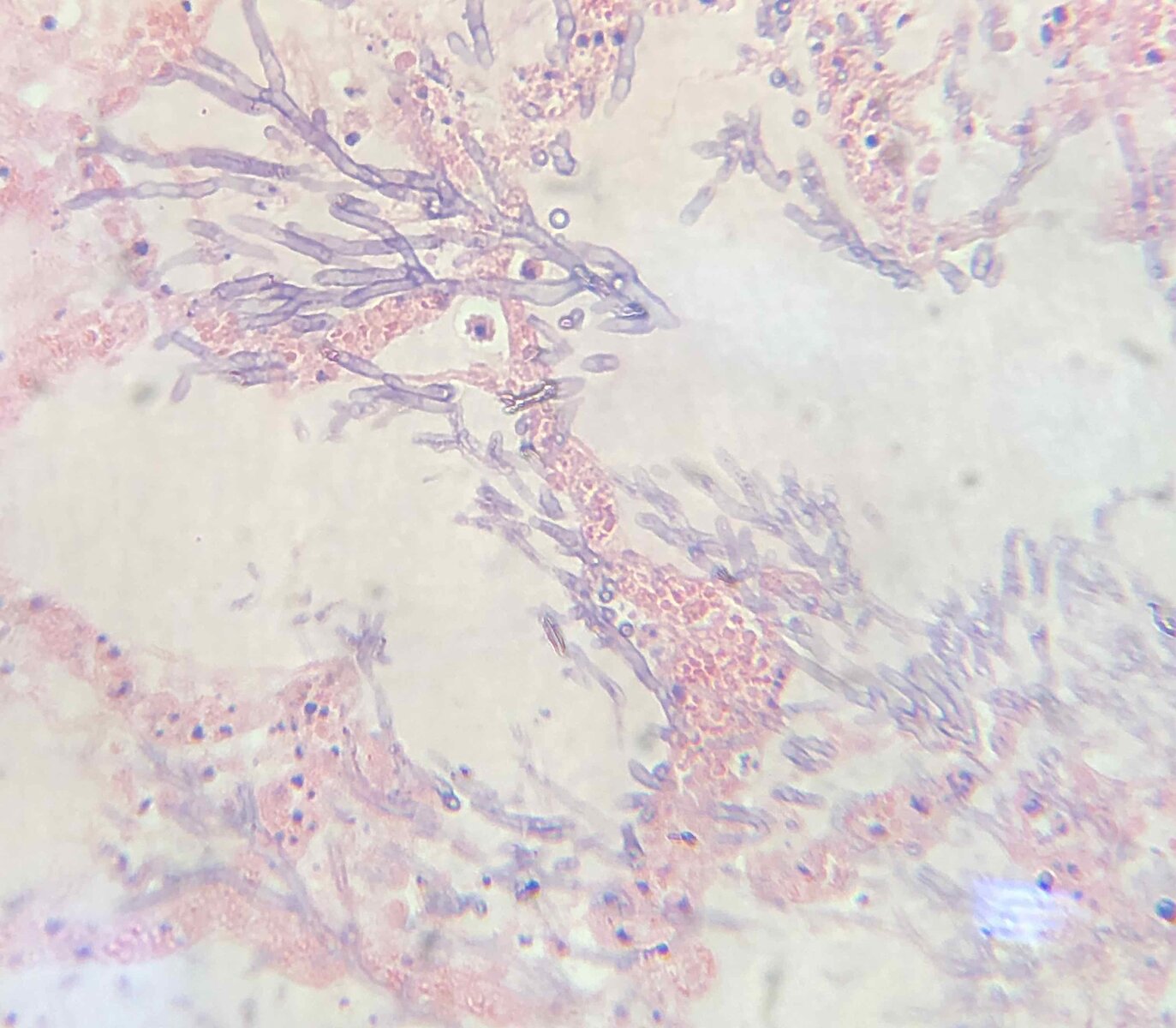 Infecções Fúngicas